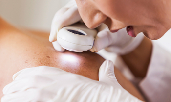 Ein Patient ist bei der Hautkrebsvorsorge. Eine junge Ärztin schaut sich mit einem Dermatoskop die Muttermale auf einem Rücken an.
