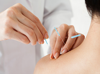 Akupunktur-Behandlung mit Nadeln