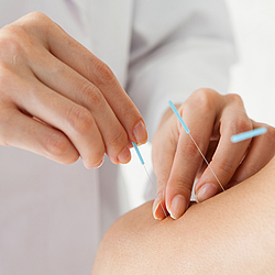 Akupunktur-Behandlung mit Nadeln