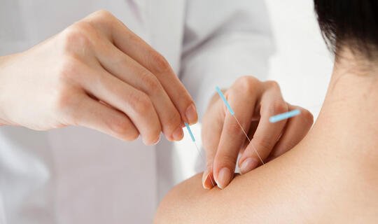 Akupunktur-Behandlung mit Nadeln