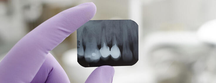 Finger mit Handschuhen halten Röntgenaufnahmen von Zähnen